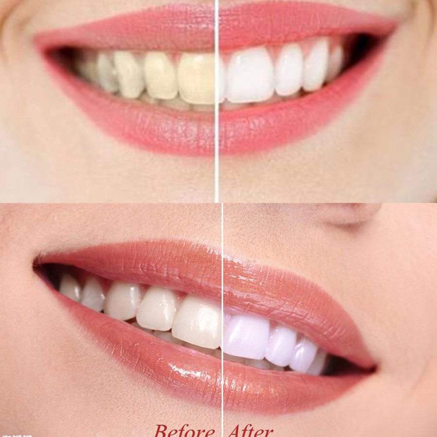 Bambu kömür diş diş diş hekimi - Teeth Whitening Results incelemesi ve fiyatı