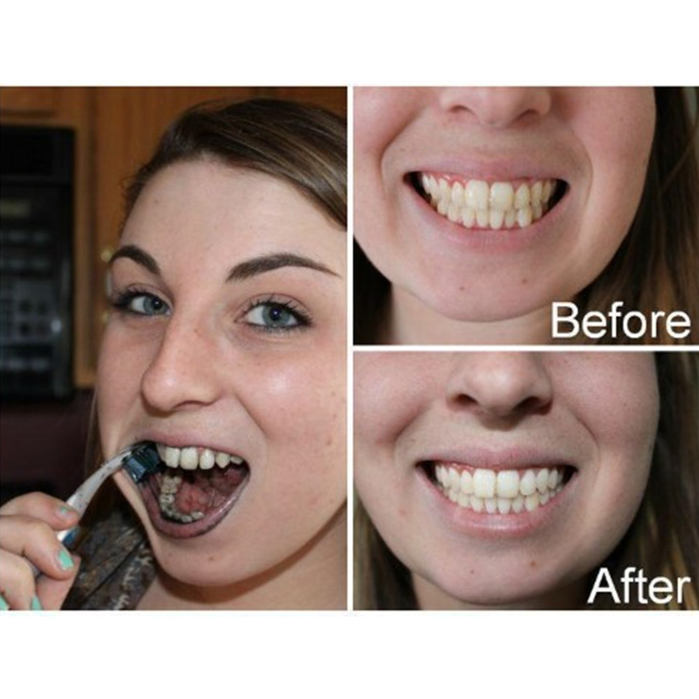 Bambu kömür diş diş diş hekimi - Teeth Whitening Results incelemesi ve fiyatı