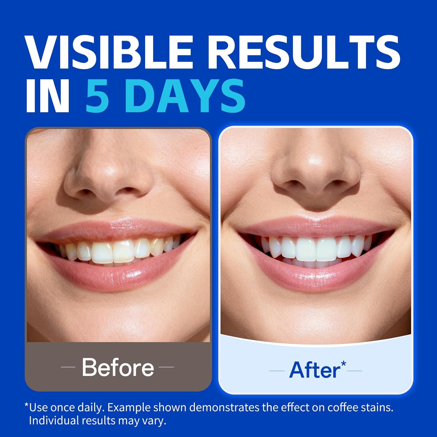 7 çift Diş Beyazlatma Şeritler - Teeth Whitening Street incelemesi ve fiyatı