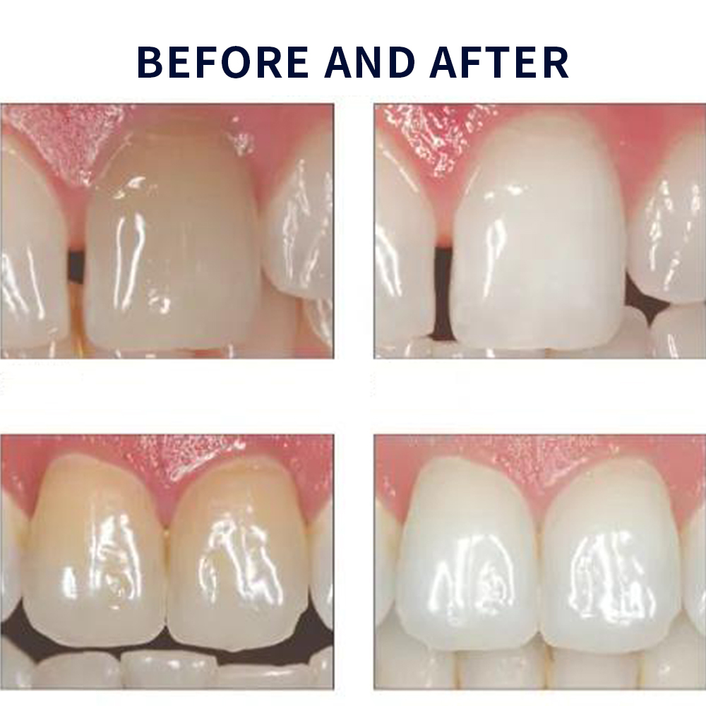 Opalescence beyazlatma 20% PF  - Teeth Whitening Results incelemesi ve fiyatı