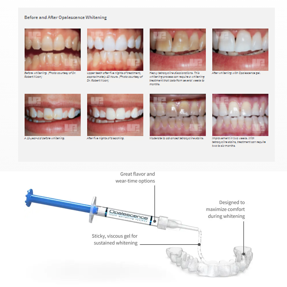 Opalescence beyazlatma 20% PF  - Teeth Whitening Results incelemesi ve fiyatı